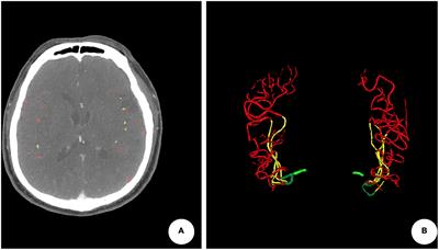 Quantitative collateral score for the prediction of clinical outcomes in stroke patients: Better than visual grading